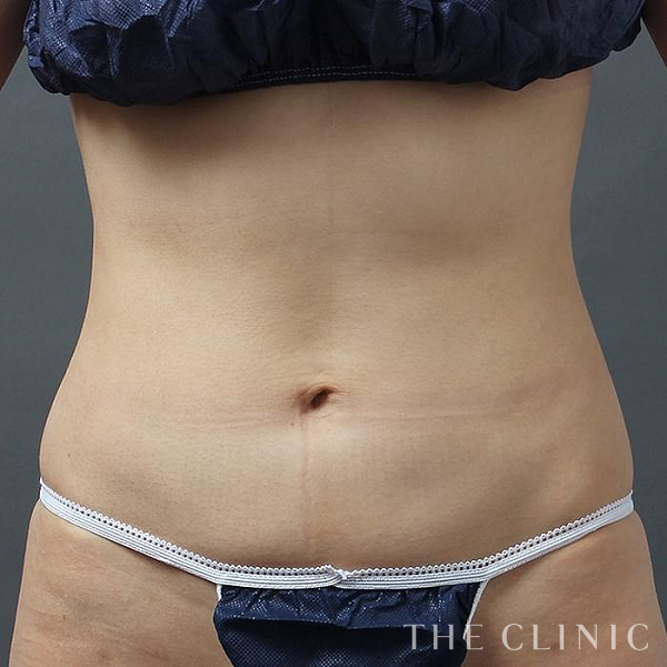 腹部のベイザー脂肪吸引（29歳女性）の術後写真