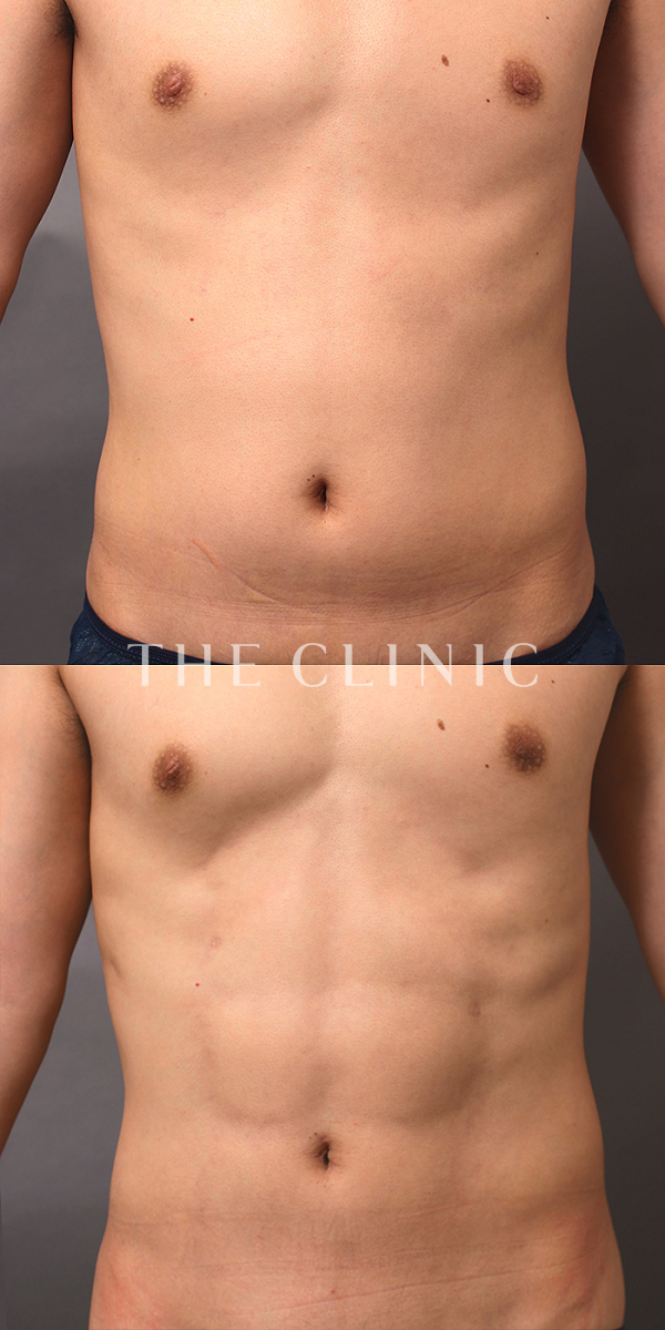 胸部のデザイン・SIX PACK ６つに割れた腹筋のベイザー4D(男性のシックスパック脂肪吸引)（30歳男性）の術前・術後写真