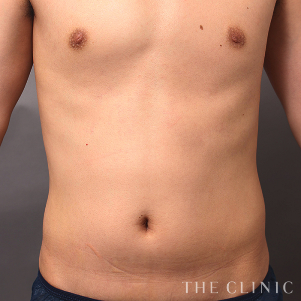胸部のデザイン・SIX PACK ６つに割れた腹筋のベイザー4D(男性のシックスパック脂肪吸引)（30歳男性）の術前写真