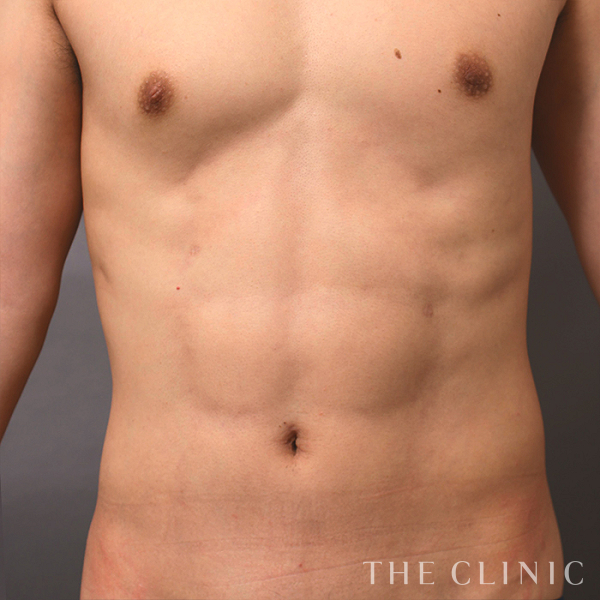 胸部のデザイン・SIX PACK ６つに割れた腹筋のベイザー4D(男性のシックスパック脂肪吸引)（30歳男性）の術後写真