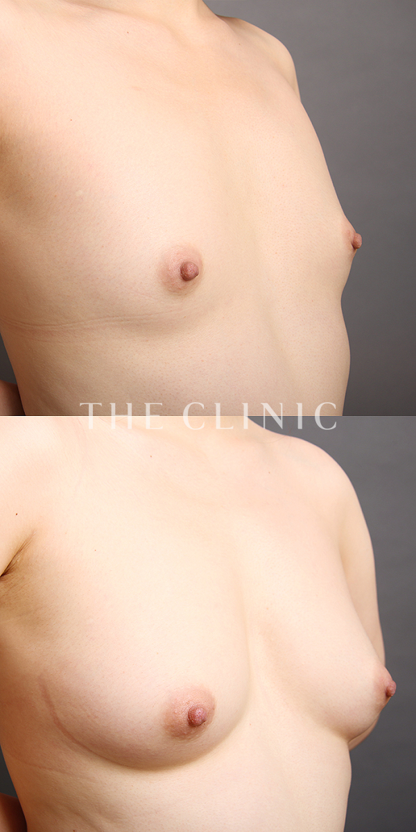 ボリュームアップのコンデンスリッチ豊胸（33歳女性）の術前・術後写真