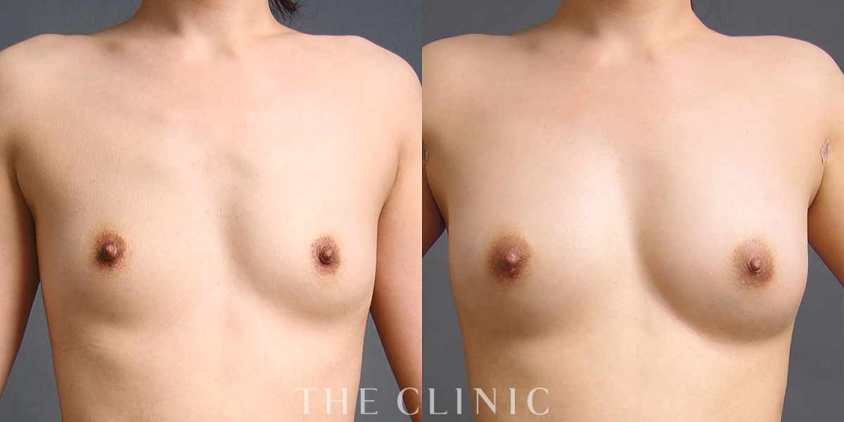 コンデンスリッチ豊胸の術前/術後