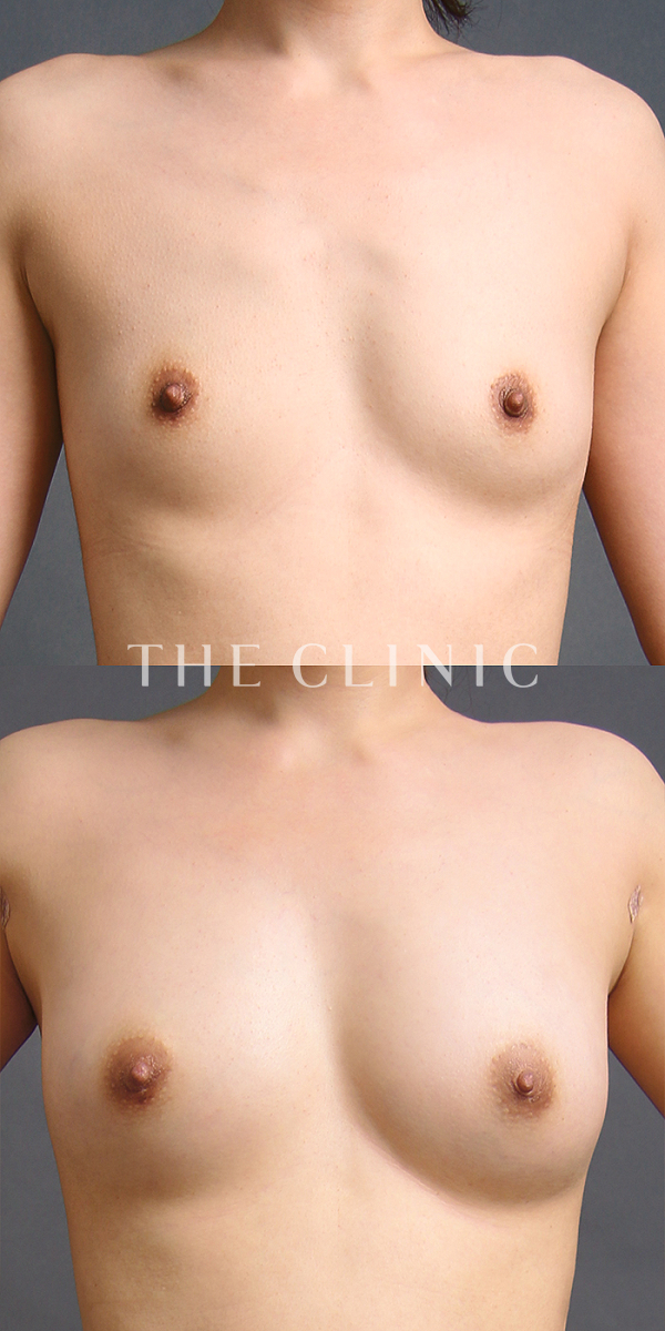 ボリュームアップのコンデンスリッチ豊胸（32歳女性）の術前・術後写真