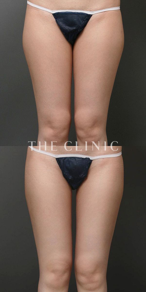 太もものベイザー脂肪吸引（33歳女性）の術前・術後写真