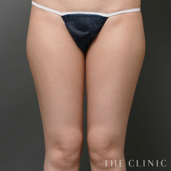 太もものベイザー脂肪吸引（33歳女性）の術前写真