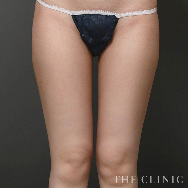 太もものベイザー脂肪吸引（33歳女性）の術後写真