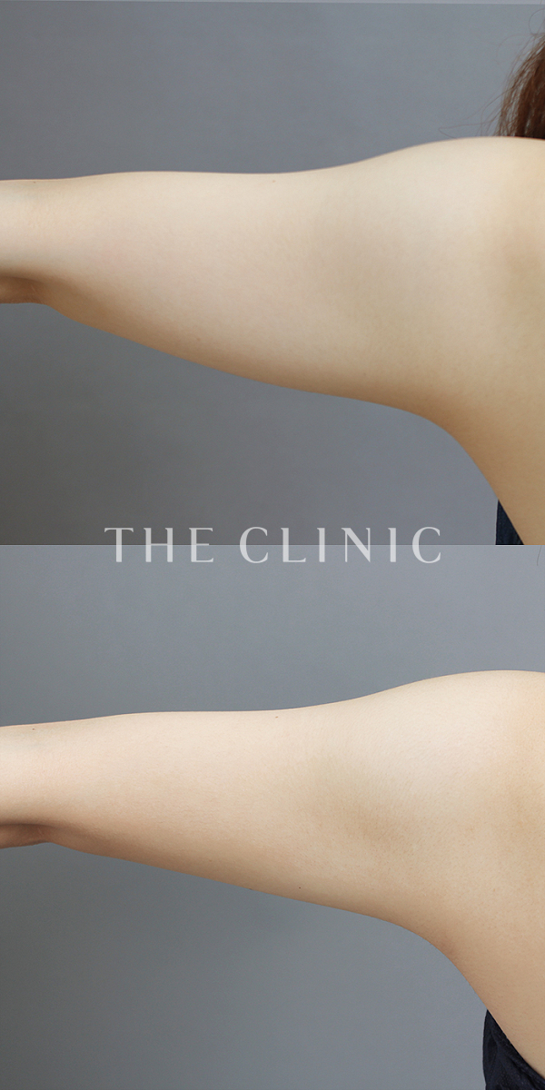 二の腕のベイザー脂肪吸引（24歳女性）の術前・術後写真