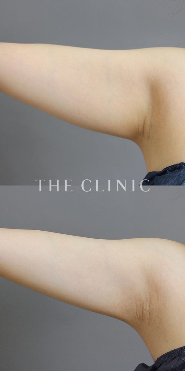 二の腕のベイザー脂肪吸引（24歳女性）の術前・術後写真