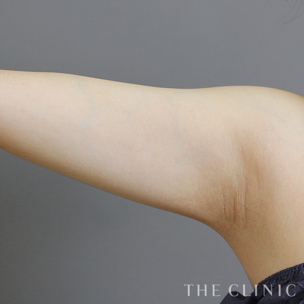 二の腕のベイザー脂肪吸引（24歳女性）の術後写真