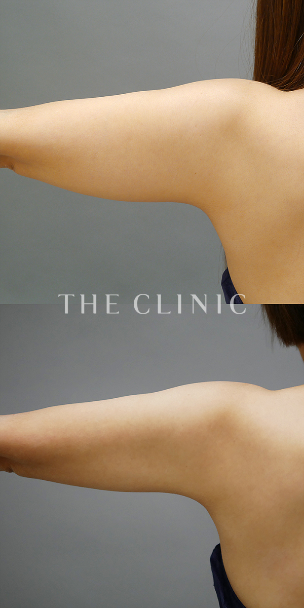 二の腕のベイザー脂肪吸引（34歳女性）の術前・術後写真