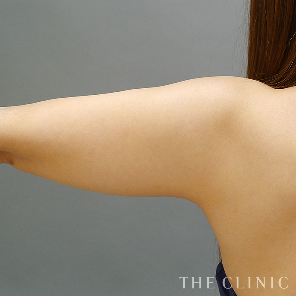 二の腕のベイザー脂肪吸引（34歳女性）の術前写真