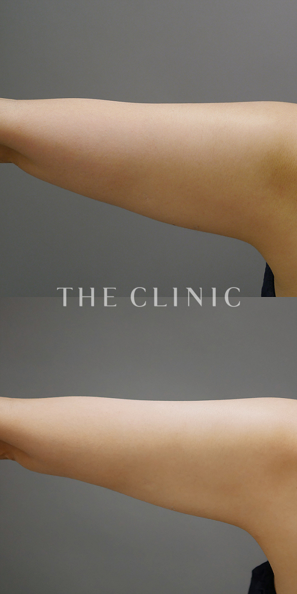 二の腕のベイザー脂肪吸引（41歳女性）の術前・術後写真