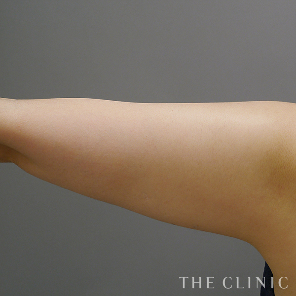 二の腕のベイザー脂肪吸引（41歳女性）の術前写真