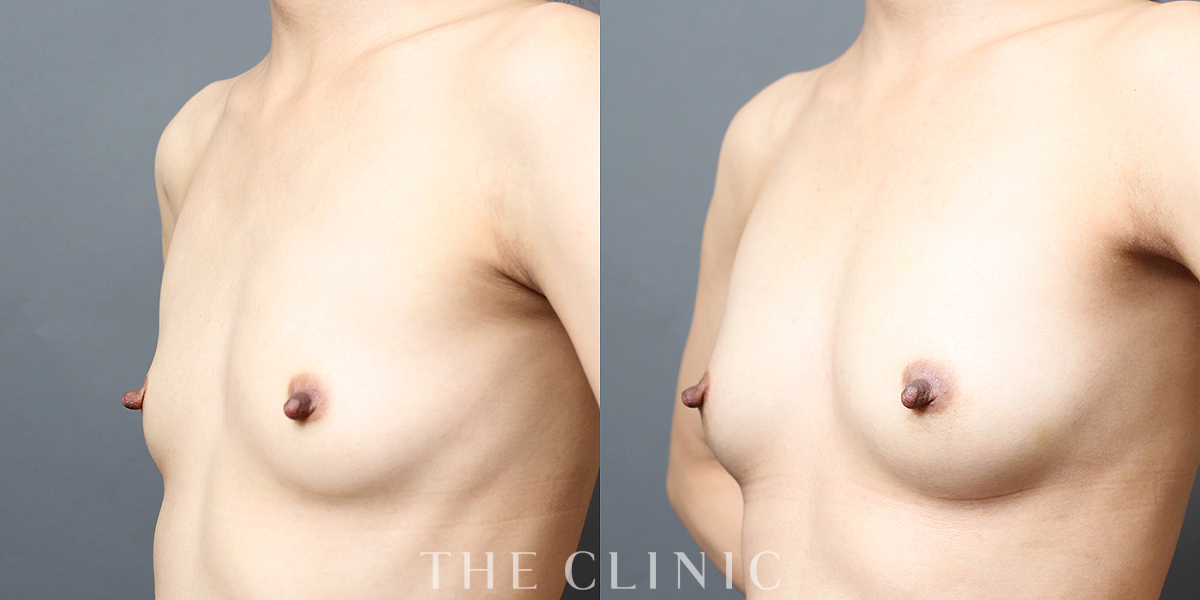 コンデンスリッチ豊胸の術前／術後