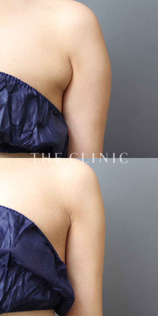 二の腕・腕の付け根のベイザー脂肪吸引（30歳女性）の術前・術後写真