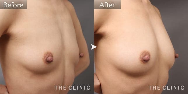 ボリュームアップ(女性/44歳)