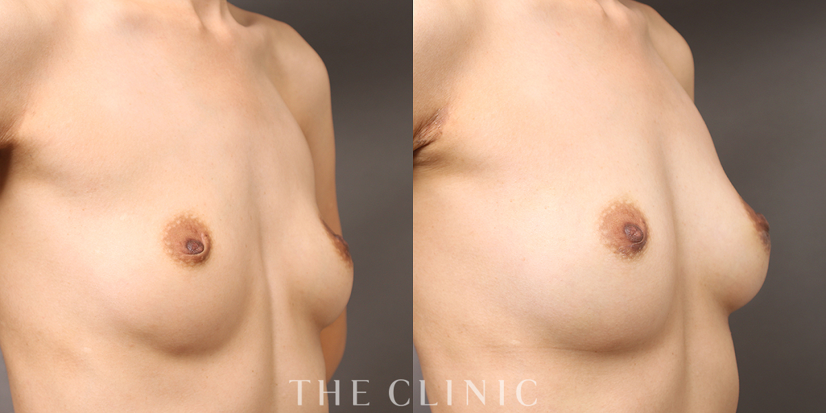 コンデンスリッチ豊胸の術前／術後