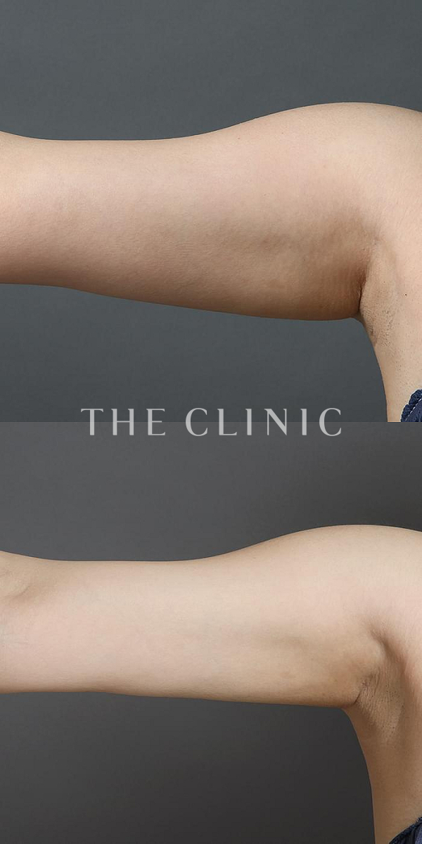 二の腕のベイザー脂肪吸引（29歳女性）の術前・術後写真