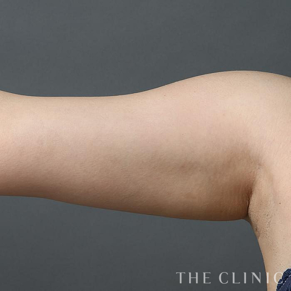 二の腕のベイザー脂肪吸引（29歳女性）の術前写真