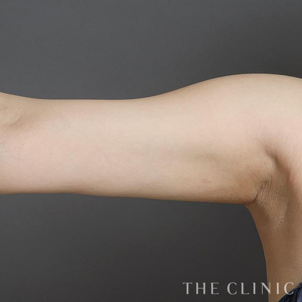 二の腕のベイザー脂肪吸引（29歳女性）の術後写真