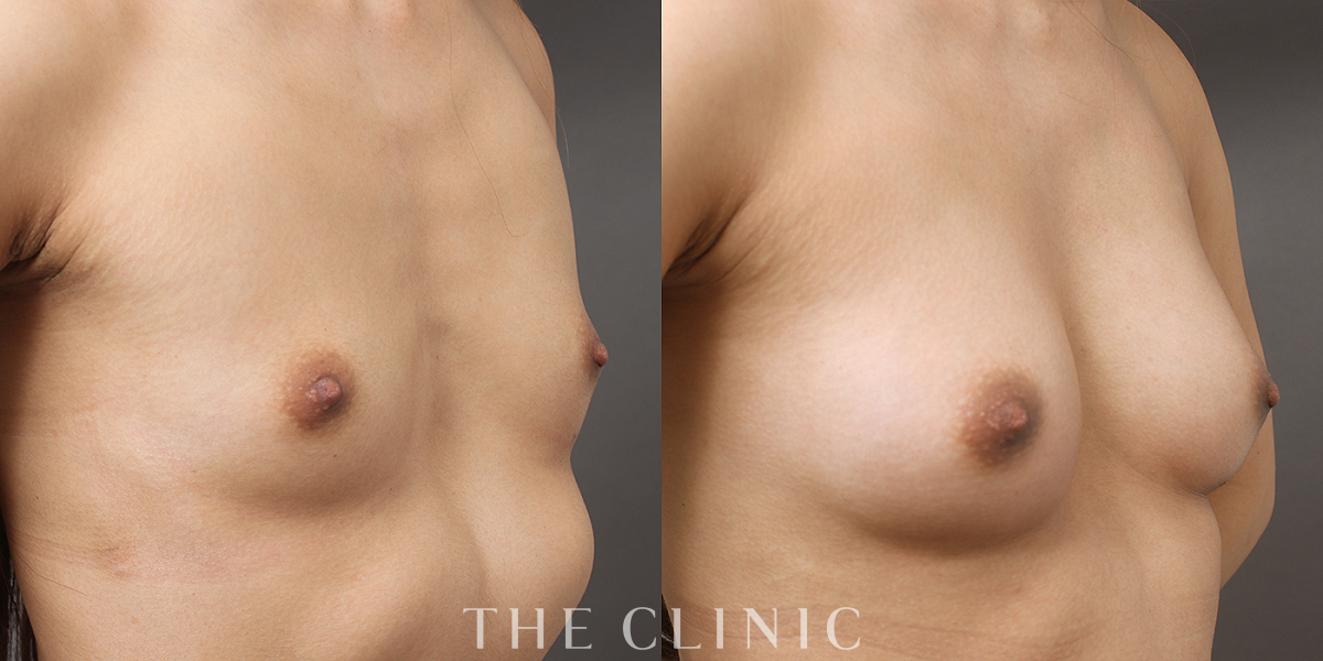 BRAVA×コンデンスリッチ豊胸の術前/術後