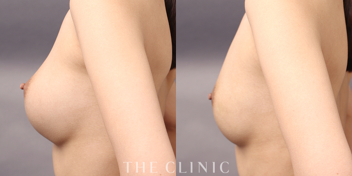 豊胸シリコンバッグ除去の術前／術後