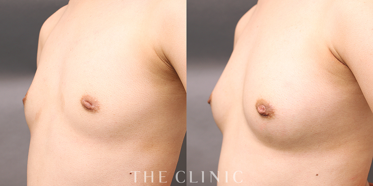 コンデンスリッチ豊胸の術前/術後