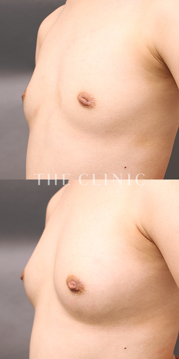 ボリュームアップのコンデンスリッチ豊胸（22歳女性）の術前・術後写真