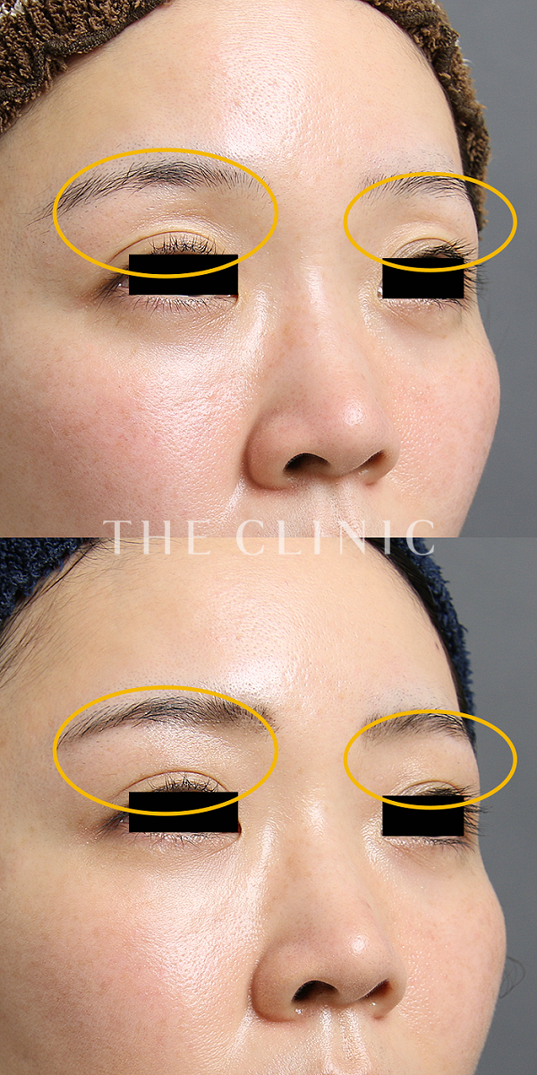 目の上のくぼみのマイクロCRF注入(顔の脂肪注入)（32歳女性）の術前・術後写真