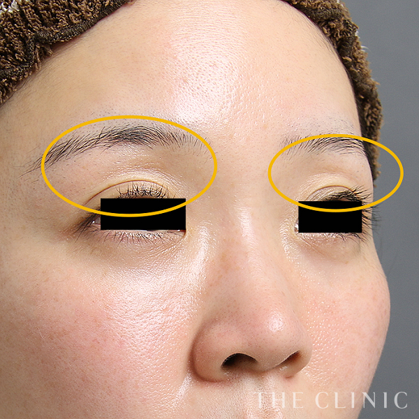 目の上のくぼみのマイクロCRF注入(顔の脂肪注入)（32歳女性）の術前写真