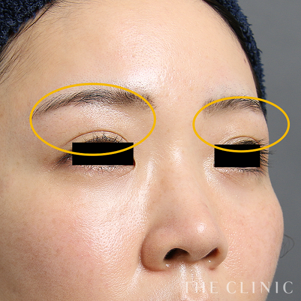 目の上のくぼみのマイクロCRF注入(顔の脂肪注入)（32歳女性）の術後写真