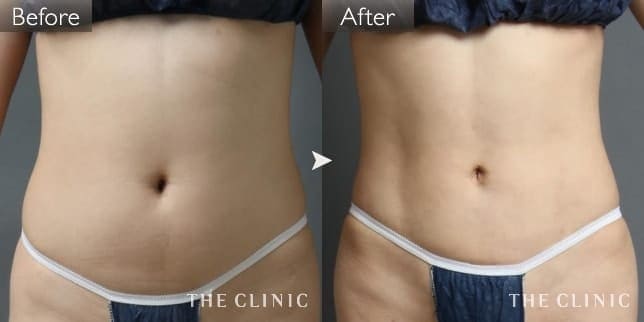 腹部（女性／33歳）