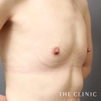 【THE CLINIC 症例画像】No.810_1_ボリュームアップ_BRAVA×コンデンスリッチ豊胸(執刀医:)