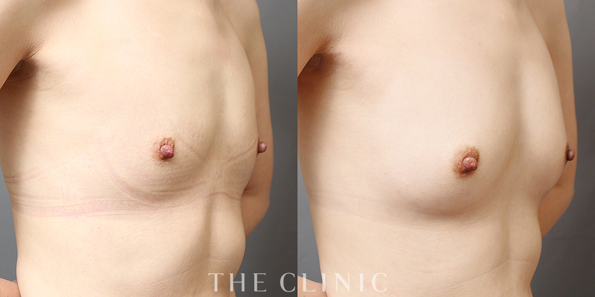 BRAVA×コンデンスリッチ豊胸の術前／術後