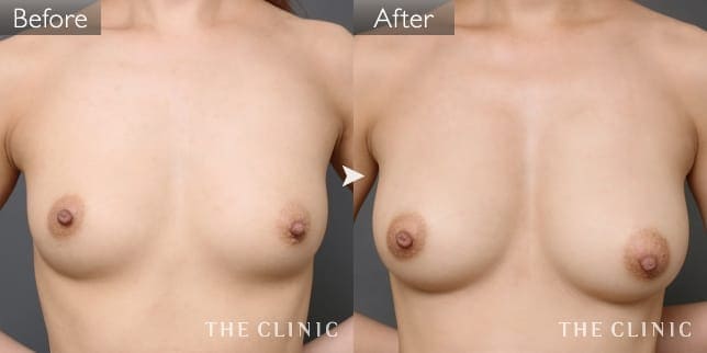 ボリュームアップ（女性／28歳）