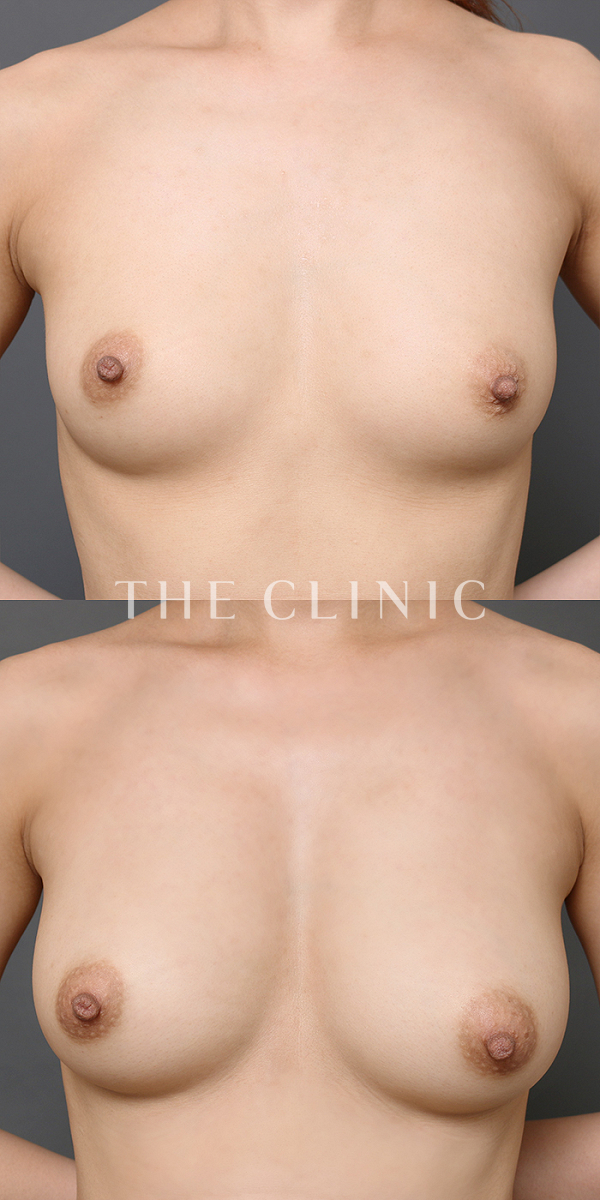 ボリュームアップのコンデンスリッチ豊胸（28歳女性）の術前・術後写真