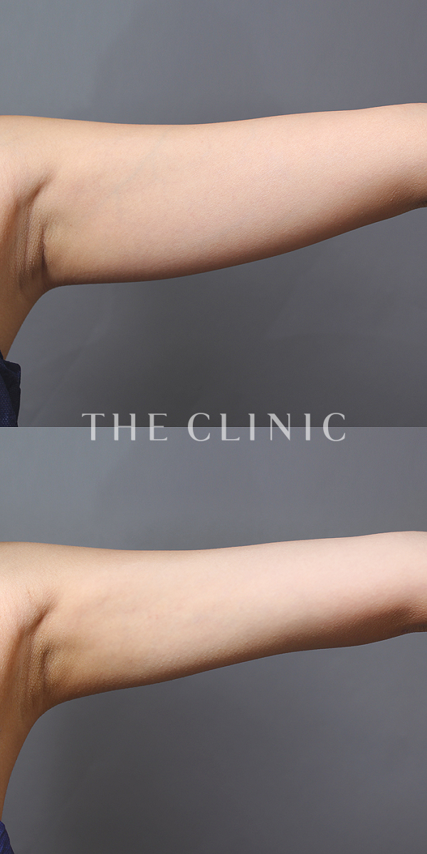 二の腕のベイザー脂肪吸引（21歳女性）の術前・術後写真