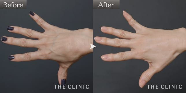 手のシワの手（女性／56歳）