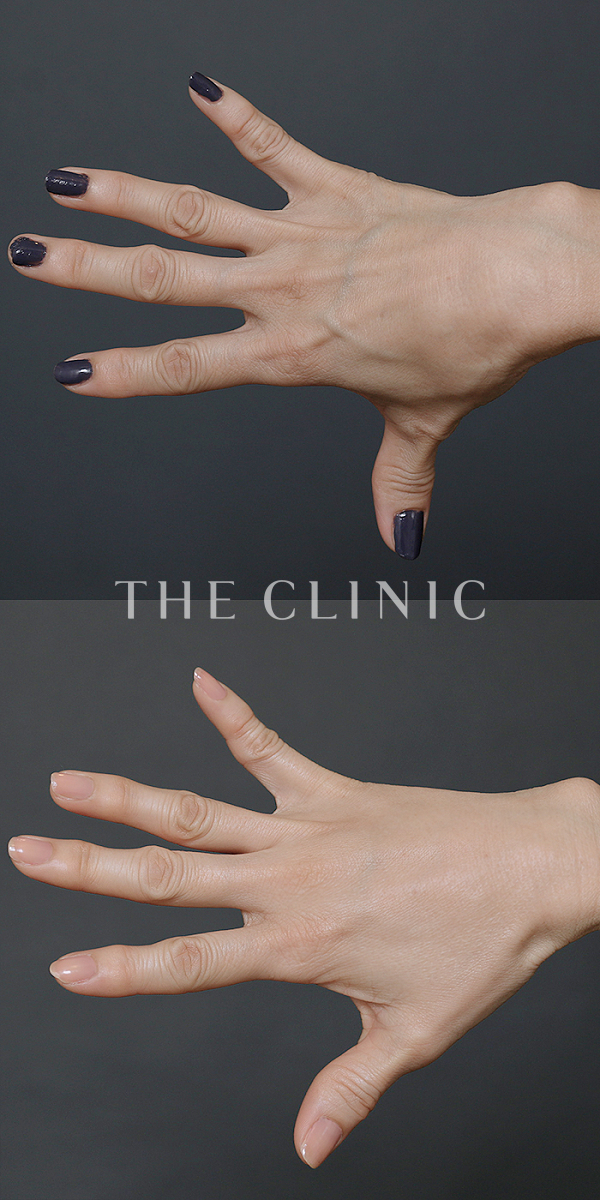 手のシワの手の甲への脂肪注入(ハンドリバイブ)（56歳女性）の術前・術後写真