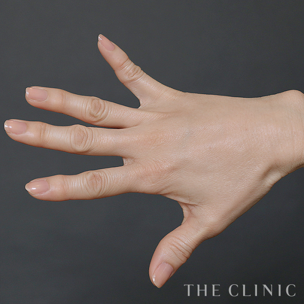 手のシワの手の甲への脂肪注入(ハンドリバイブ)（56歳女性）の術後写真