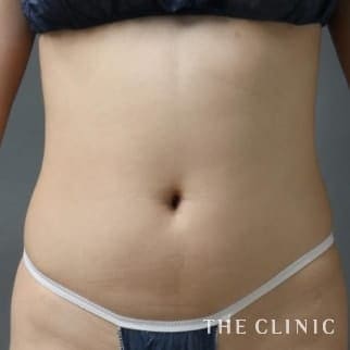 【THE CLINIC 症例画像】No.81_1_腹部_4D脂肪吸引(4Dリポ)