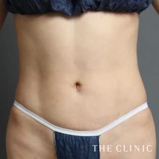 【THE CLINIC 症例画像】No.81_2_腹部_4D脂肪吸引(4Dリポ)
