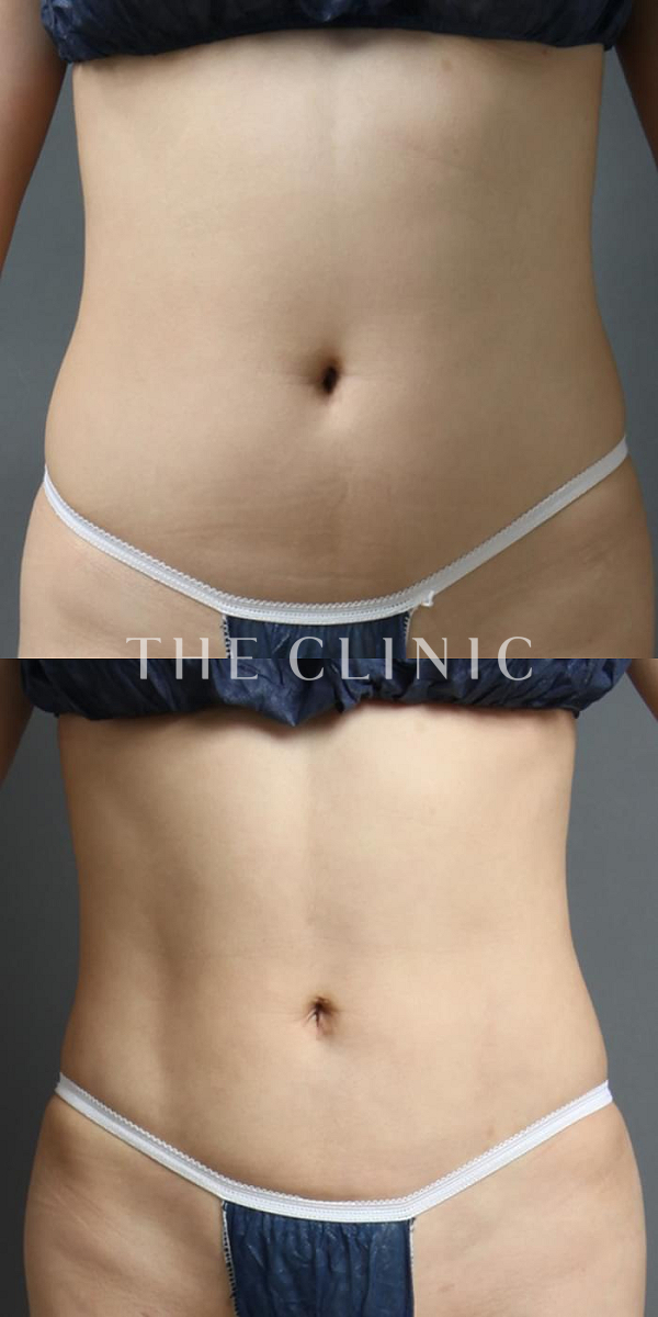 腹部の4D脂肪吸引(4Dリポ)（33歳女性）の術前・術後写真