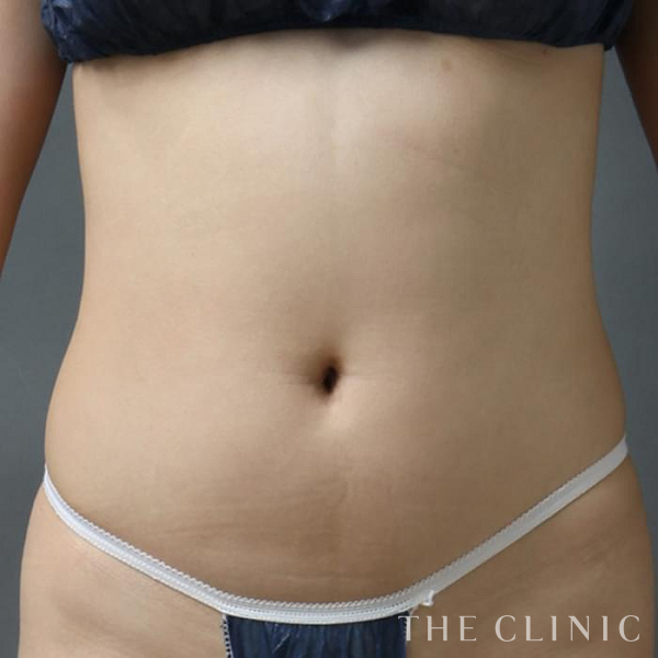 腹部の4D脂肪吸引(4Dリポ)（33歳女性）の術前写真