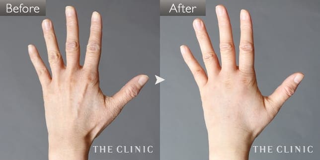 手のシワの手（女性／38歳）