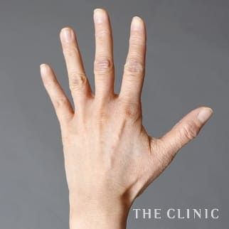 【THE CLINIC 症例画像】No.824_1_手のシワ_手の甲への脂肪注入(ハンドリバイブ)(執刀医:)