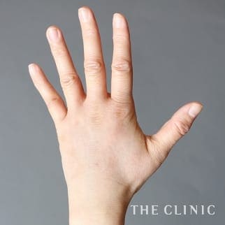 【THE CLINIC 症例画像】No.824_2_手のシワ_手の甲への脂肪注入(ハンドリバイブ)(執刀医：)