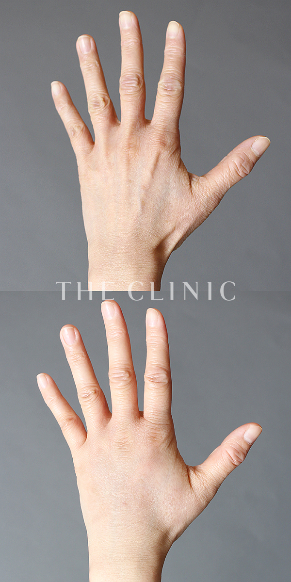 手のシワの手の甲への脂肪注入(ハンドリバイブ)（38歳女性）の術前・術後写真