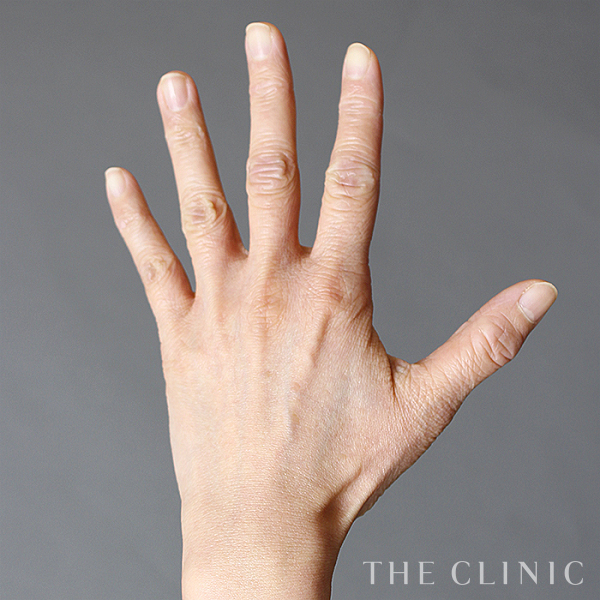 手のシワの手の甲への脂肪注入(ハンドリバイブ)（38歳女性）の術前写真