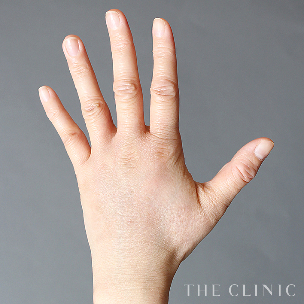 手のシワの手の甲への脂肪注入(ハンドリバイブ)（38歳女性）の術後写真